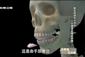 小伙摔倒咬断舌头，医生紧急缝合却发现小伙摔倒的主要原因！