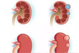 成人多囊肾，属于遗传性疾病，可导致肾小管堵塞对肾功能造成损害图片
