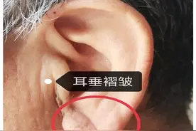 “鼻根有横纹，耳垂有褶皱”就表示有冠心病吗？图片