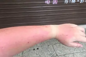 紫外线过敏该怎么办？营养师：不妨多吃这些食物，有帮助图片