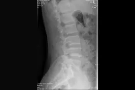 急性腰扭伤图片