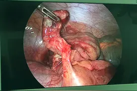 化脓性阑尾炎图片