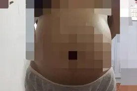 十八岁女子怀2胎，九个月时肚子疼送医院，剖开肚皮医生都哭了图片