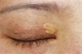 眼睛边出现这种小肉粒，多半是血脂高了，饭后坚持一件事稳定血脂图片
