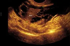 盆腔积液是怎么引起的？