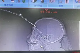 吓人！9岁女孩额头插入一把剪刀，万幸手术拔出时未出血图片