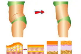 韩啸医生详解大腿吸脂术后疼痛原因及缓解方法图片