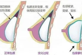 假体隆胸包膜挛缩是影响术后效果和手感的重要原因？图片