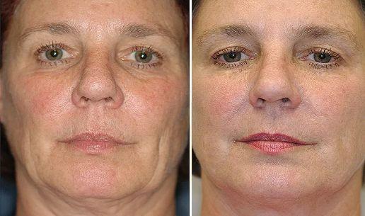 经常长痘能吃花胶吗 2026年长痘的人可以吃花胶吗