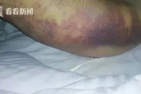 美丽的谎言①：病危、流产，大腿抽脂术把她送进ICU图片