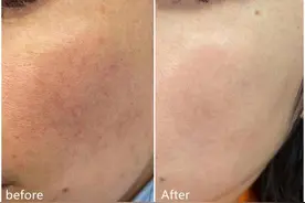 如何靠医美把皮肤养好？入门级医美护肤安利图片