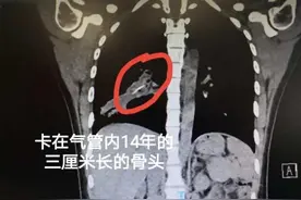 22岁女大学生咳嗽顽疾，竟然是因为一条赖了14年的鱼骨图片