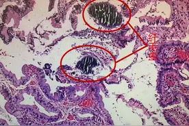 杭州女子因腹痛入院发现感染寄生虫，原来是生吃三文鱼惹得祸图片