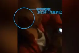 女童被阿拉斯加犬咬伤脸，警方介入视频封面