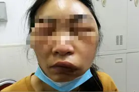 昨夜急诊 | 睡梦中被虫子咬了一口，嘉兴阿姨肿得眼斜口歪，还险些窒息图片