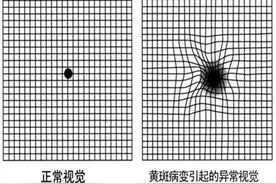 视物扭曲或有黑影当心黄斑病变，四类眼底病就医别拖延图片