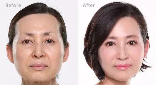 长期吃胶原蛋白有什么副作用 2026年长期吃胶原蛋白有什么副作用和危害