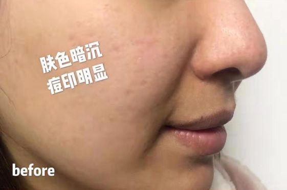 长期吃胶原蛋白有什么副作用 2026年长期吃胶原蛋白有什么副作用和危害