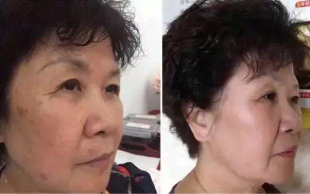 长期吃胶原蛋白有什么副作用 2026年长期吃胶原蛋白有什么副作用和危害