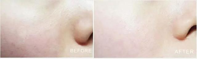 长期吃胶原蛋白有什么副作用 2026年长期吃胶原蛋白有什么副作用和危害