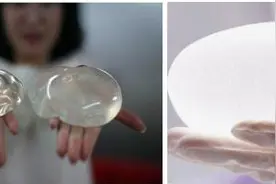 假体隆胸术后包膜挛缩手术治疗效果图片