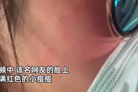 姑娘满脸红痘竟是长了脚气？爱“吸猫”的人一定要当心图片