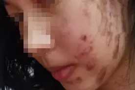 女子“自费毁容”，脸蛋被烧伤还长出N条黑色素……图片