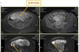 26岁姑娘体检发现盆腔内巨大包块，半年后竟疯长到22cm！这颗形似“蘑菇”的肌瘤不仅罕见而且非常危险图片