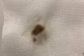 杭州姑娘一觉醒来听不见了！医生从她耳朵里挖出一大坨脏东西图片