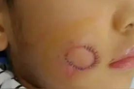 急诊科故事㉔|5岁男孩脸颊戳了个洞，医生妙手还他“微笑”图片