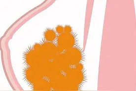 解析奥美定隆胸后遗症修复取出手术研究进展图片