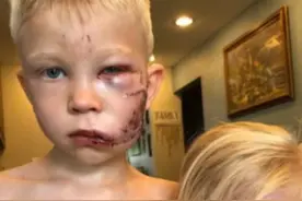 男孩恶犬口下救妹妹缝90针，世界拳协授予其拳王腰带图片