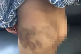 33岁男子多次殴打双胞胎儿子致下肢大面积淤青，被批捕图片