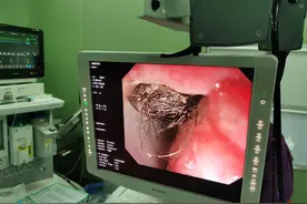 9岁女孩呕吐数日送入急诊 医生惊呆：胃里竟全是头发图片