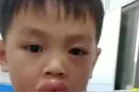 小萌娃吃葡萄过敏肿成嘟嘟嘴，爸爸的反应亮了图片