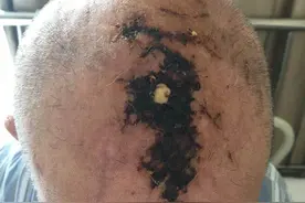 同济大学附属同济医院整形美容外科团队皮瓣转移一期修复大面积头皮坏死伴颅骨外露图片