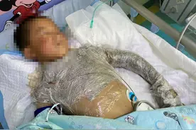 野外遇到“花蘑菇”，男孩摸了一下，整个手瞬间变黑生命垂危图片