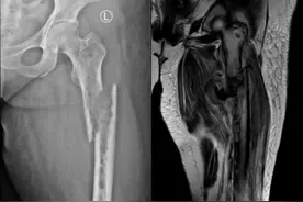 兰大二院骨科成功实施两例瘤段切除，人工假体置换重建术图片
