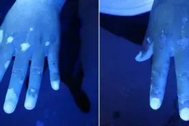 20岁小伙喝鸡汤手部被烫伤，留下疤痕又长白癜风图片