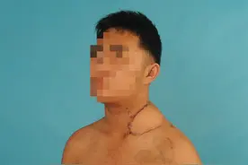 绝地反击！14岁少年颈部肿瘤多次手术复发破溃，专家团队4小时完美切除重建图片