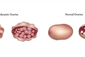 一文讲透多囊卵巢综合征（PCOS）图片