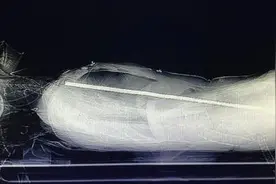 惊险！女子高空坠落被71cm钢筋贯穿，医生却直呼“奇迹”图片