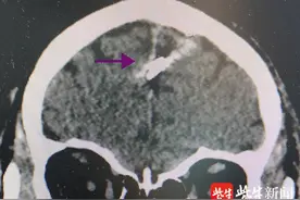 “灭顶之灾”！4厘米的大铁钉插入男子脑内，鼓楼医院神经外科紧急取钉图片