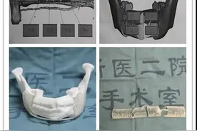 18岁大学生发现左右脸不对称，竟是下颌骨长了肿瘤，只好保命截去半张脸……图片