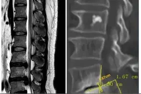 「筋骨堂」得了腰椎病怎么办？保腰团队给您建议图片