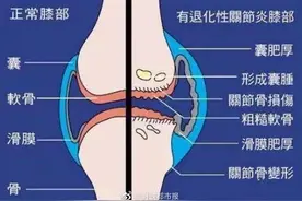 关节为什么会咔咔响？图片