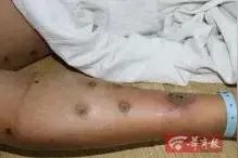 小心！西安已有多名儿童遭此物攻击，一名患儿目前还在抢救中图片