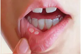 什么是口腔溃疡，如何医治口腔口腔溃疡？图片
