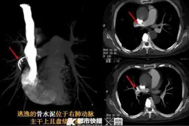 8年前一场手术，8年后命悬一线，罪魁祸首是骨水泥图片