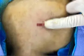 聚焦·宽仁前沿｜第8期，脖子上“钻”个小孔，烦扰多时的颈椎病竟然就好了？图片